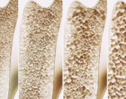 Osteoporose: com que idade devo começar a prevenção?